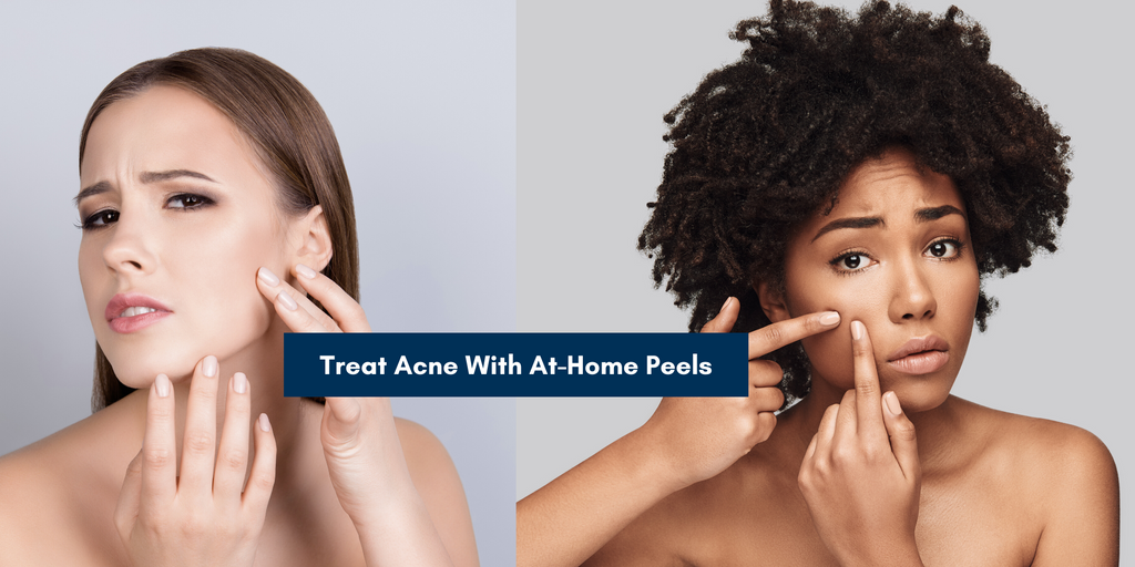 Treat Acne with Skin peels