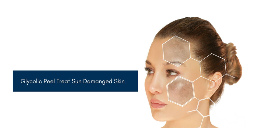 Glycolic Facial Peels Help With Summer Sun Damaged Skin