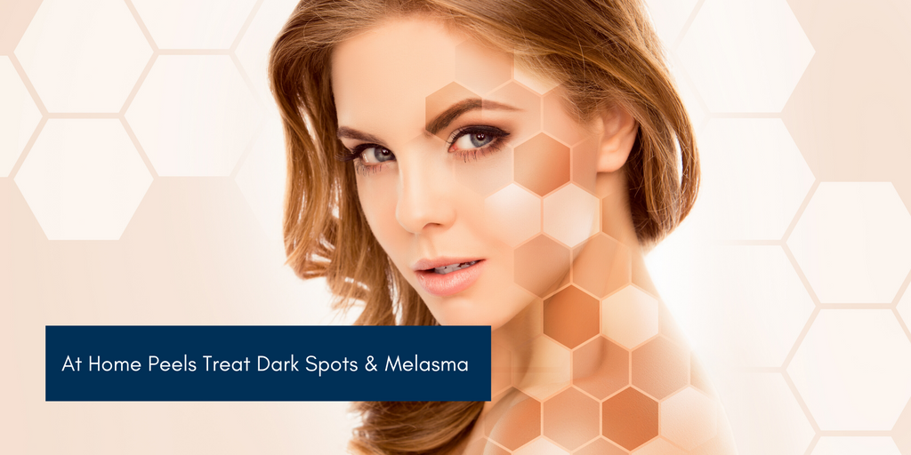 Skin Peels For Dark Spots  & Melasma