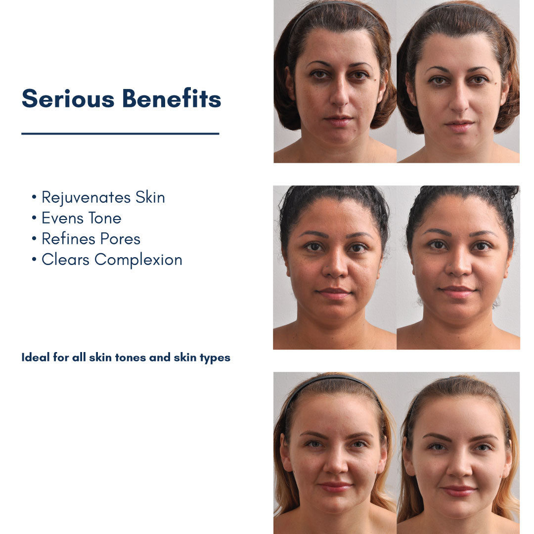 RETEXTURIZING SKIN PEEL - Glycolic Chemical At-Home Facial Treatment Kit